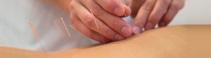 Medical Acupuncture Treatments at Perry Medical Clinic
